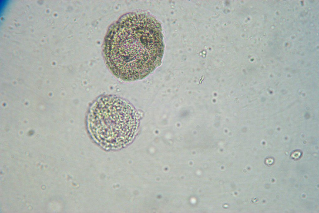 White blood cells in urine