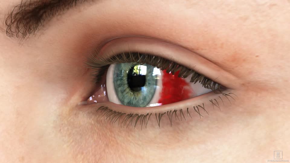 Broken blood vessel in eye