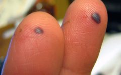 Understanding Blood Blisters: Causes, Symptoms, and Treatment