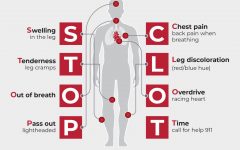 Blood Clot Symptoms: An Essential Guide to Recognizing and Responding