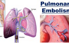 Blood Clots in the Lung: A Comprehensive Guide to Understanding and Managing This Serious Condition