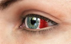 Broken Blood Vessel in Eye: Causes, Symptoms, and Treatment